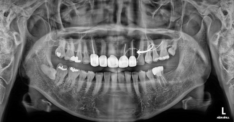 부러진 앞니 부위를 표시한 초진 파노라마 X-ray