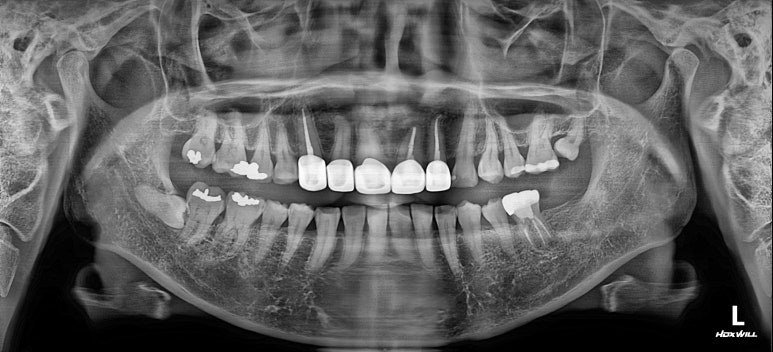 치아재식술 전 초진 파노라마 X-ray