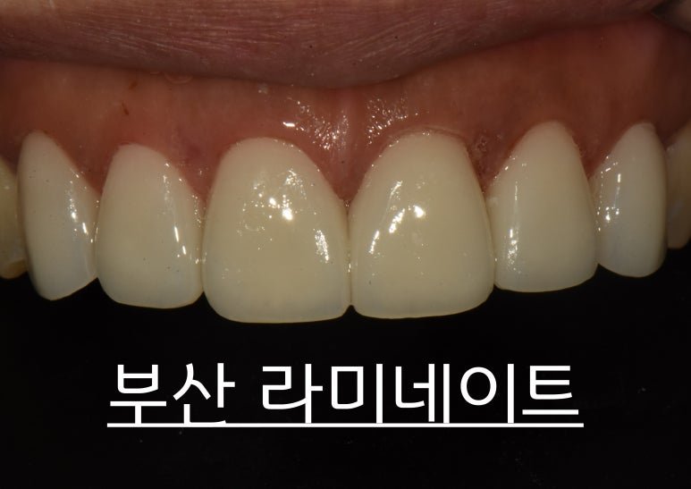 부산 라미네이트 치료 사례 대표 이미지