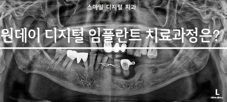 원데이 디지털 임플란트 치료과정 안내 대표 이미지