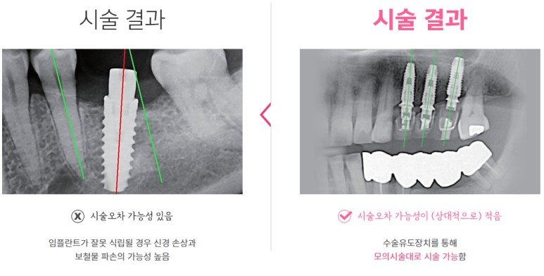 디지털 가이드 임플란트 시술 전 계획과 시술 결과 비교