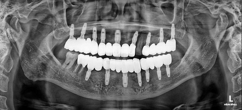 수술 직후 파노라마 X-ray