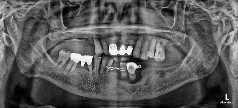 원데이 임플란트 치료 전 파노라마 X-ray