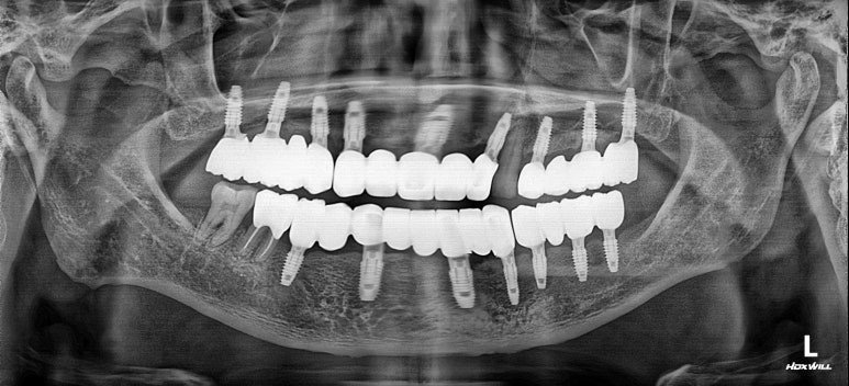 2026년 7월 13일 정기검진 파노라마 X-ray