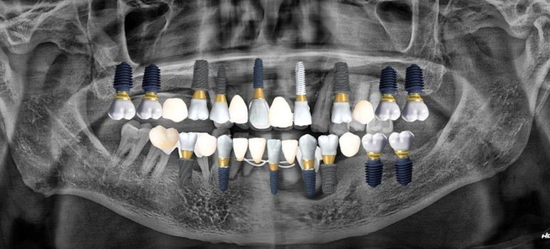 원데이 임플란트 치료 계획을 표시한 파노라마 X-ray