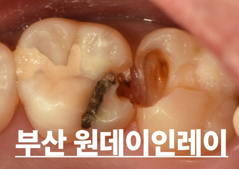 부산 원데이 인레이 충치치료 사례 대표 이미지