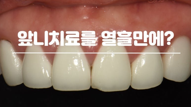 해외 거주 환자 앞니 크라운 재치료 10일 사례 대표 이미지
