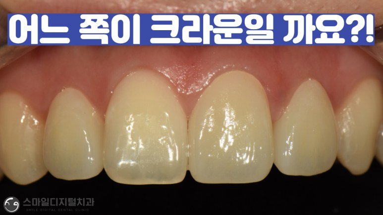 어느 쪽이 크라운일까요 오래된 앞니 PFM 크라운 재치료 사례