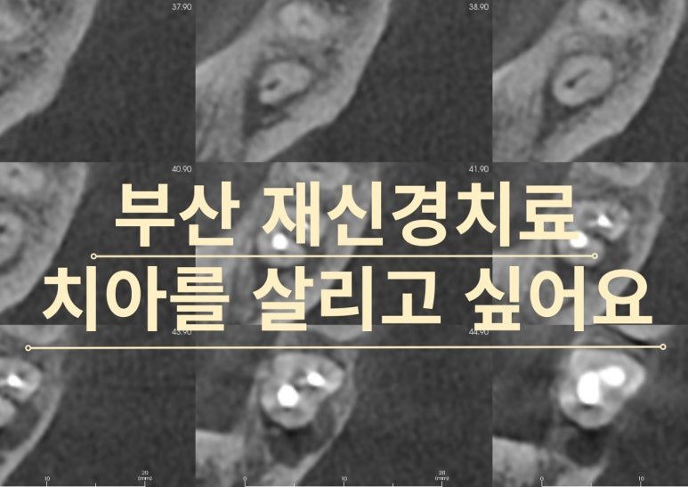 부산 재신경치료 사례 대표 이미지