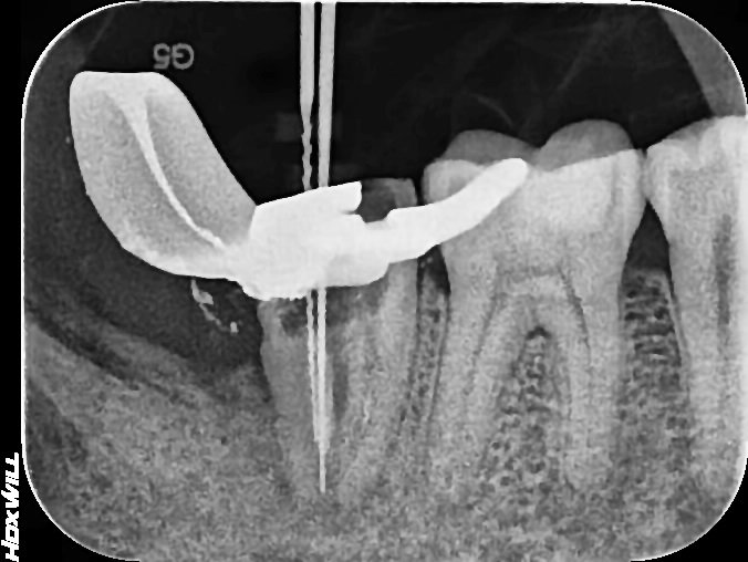 파일을 이용해 근관 길이를 확인하는 X-ray