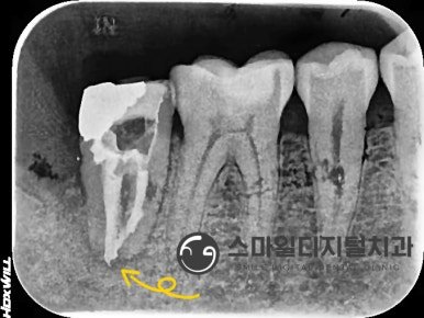재신경치료 후 근관충전 X-ray