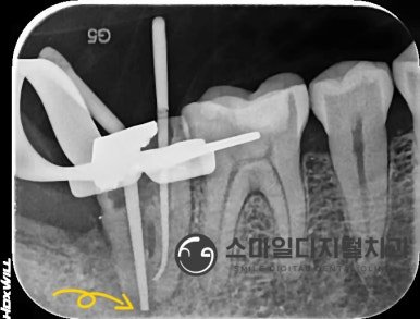 재신경치료 중 치근단 부위까지 근관 경로를 확인한 X-ray