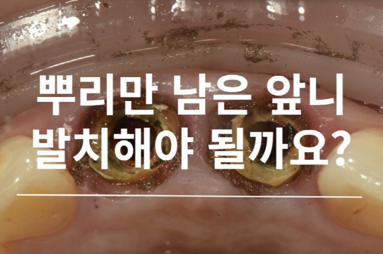 뿌리만 남은 앞니 발치해야 될까요? 금속 포스트 제거 후 남은 치근 사진