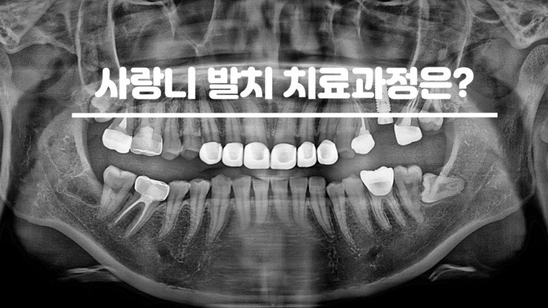사랑니 발치 치료과정은 매복 사랑니 파노라마 사진