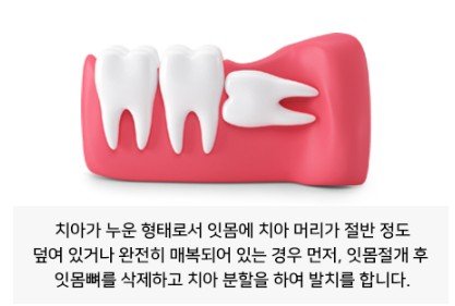 누운 형태의 매복 사랑니 모형 이미지