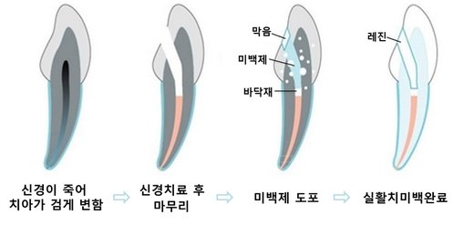 신경치료한 앞니 변색과 내부 미백 설명 이미지